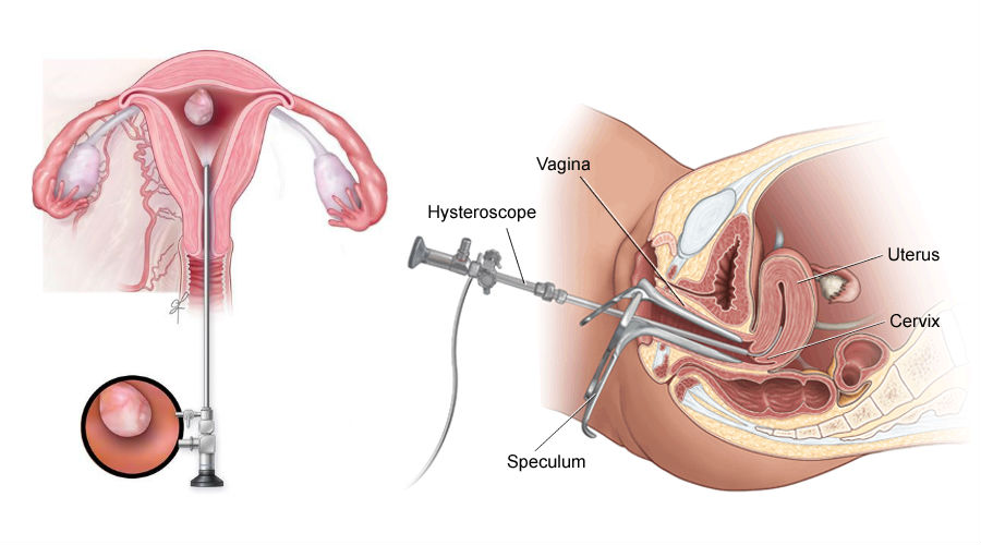 Hysteroscopy Treatment Purpose Procedure And Cost